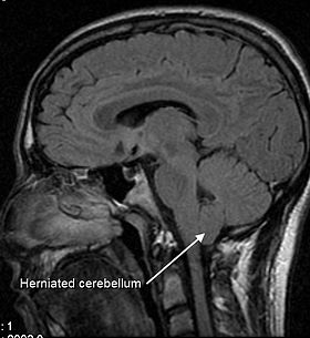 MRI_of_human_brain_with_type-1_Arnold-Chiari_malformation_and_herniated_cerebellum.jpg